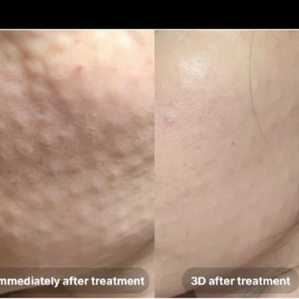 MTS + Rejuran Treatments at HH Beauty Atelier in Falls Church, VA